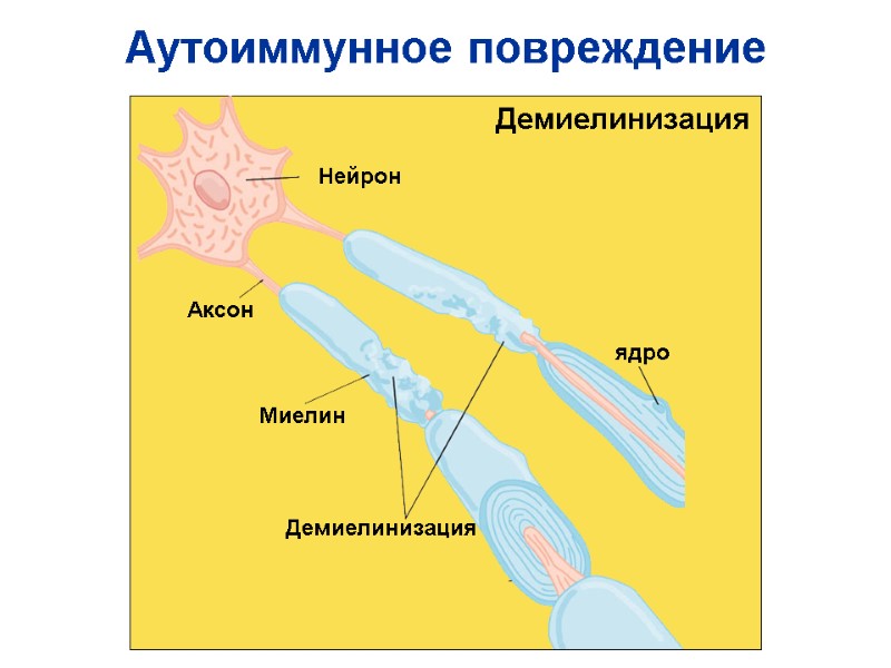 Аутоиммунное повреждение  Демиелинизация Демиелинизация Аксон Нейрон Миелин ядро